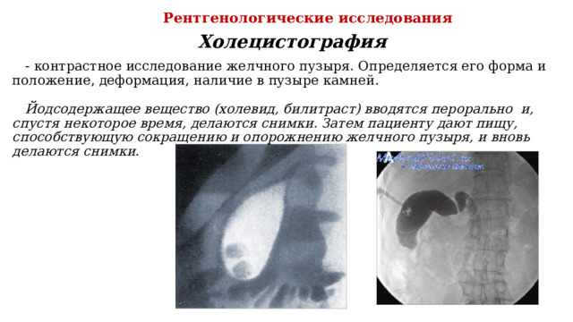 Рентгенологические исследования Холецистография - контрастное исследование желчного пузыря. Определяется его форма и положение, деформация, наличие в пузыре камней. Йодсодержащее вещество (холевид, билитраст) вводятся перорально и, спустя некоторое время, делаются снимки. Затем пациенту дают пищу, способствующую сокращению и опорожнению желчного пузыря, и вновь делаются снимки. 