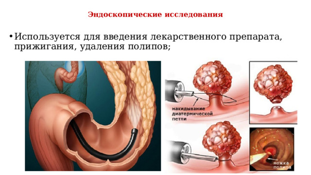 Эндоскопические исследования Используется для введения лекарственного препарата, прижигания, удаления полипов; 