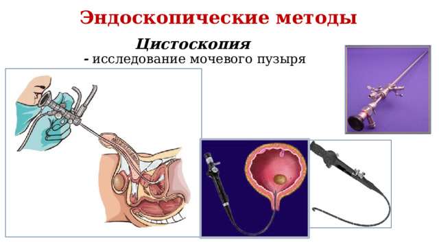 Эндоскопические методы Цистоскопия  - исследование мочевого пузыря 
