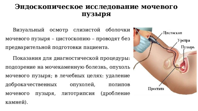 Эндоскопическое исследование мочевого пузыря Визуальный осмотр слизистой оболочки мочевого пузыря – цистоскопию – проводят без предварительной подготовки пациента. Показания для диагностической процедуры: подозрение на мочекаменную болезнь, опухоль мочевого пузыря; в лечебных целях: удаление доброкачественных опухолей, полипов мочевого пузыря, литотрипсия (дробление камней). 