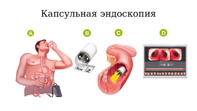 Капсульная эндоскопия 