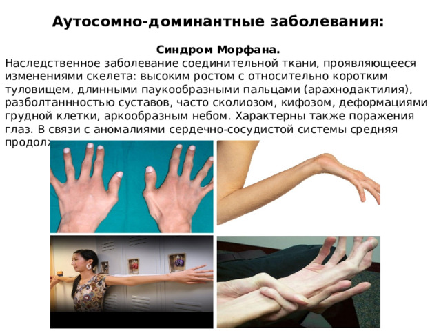  Аутосомно-доминантные заболевания:  Синдром Морфана. Наследственное заболевание соединительной ткани, проявляющееся изменениями скелета: высоким ростом с относительно коротким туловищем, длинными паукообразными пальцами (арахнодактилия), разболтаннностью суставов, часто сколиозом, кифозом, деформациями грудной клетки, аркообразным небом. Характерны также поражения глаз. В связи с аномалиями сердечно-сосудистой системы средняя продолжительность жизни сокращена. 