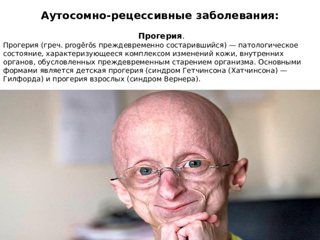 Аутосомно-рецессивные заболевания:  Прогерия . Прогерия (греч. progērōs преждевременно состарившийся) — патологическое состояние, характеризующееся комплексом изменений кожи, внутренних органов, обусловленных преждевременным старением организма. Основными формами является детская прогерия (синдром Гетчинсона (Хатчинсона) — Гилфорда) и прогерия взрослых (синдром Вернера). 