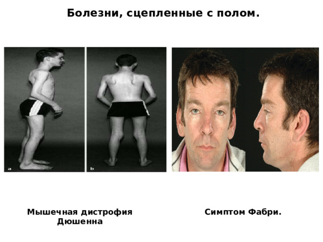  Болезни, сцепленные с полом.    Мышечная дистрофия Дюшенна Симптом Фабри. 