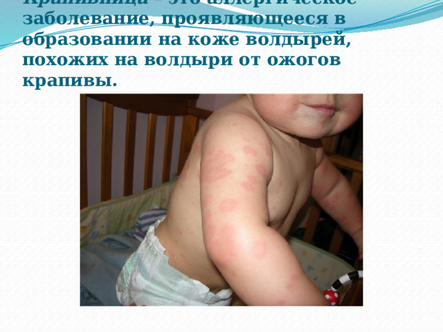 Крапивница – это аллергическое заболевание, проявляющееся в образовании на коже волдырей, похожих на волдыри от ожогов крапивы. 