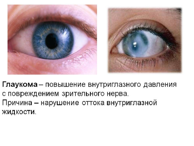 Хрусталик снабжен специальными мышцами, которые меняют его кривизну. Процесс изменения кривизны хрусталика называется АККОМОДАЦИЯ 