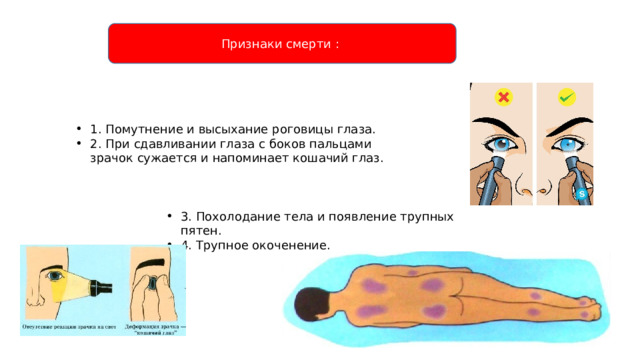 Признаки смерти : 1. Помутнение и высыхание роговицы глаза. 2. При сдавливании глаза с боков пальцами зрачок сужается и напоминает кошачий глаз. 3. Похолодание тела и появление трупных пятен. 4. Трупное окоченение. 