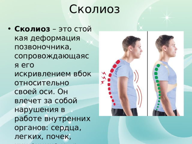 Сколиоз Сколиоз  – это стойкая деформация позвоночника, сопровождающаяся его искривлением вбок относительно своей оси. Он влечет за собой нарушения в работе внутренних органов: сердца, легких, почек, кишечника и пр. 