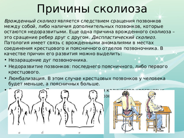 Причины сколиоза Врожденный сколиоз является следствием сращения позвонков между собой, либо наличия дополнительных позвонков, которые остаются недоразвитыми. Еще одна причина врожденного сколиоза – это сращение ребер друг с другом. Диспластический сколиоз . Патология имеет связь с врожденными аномалиями в местах соединения крестцового и поясничного отделов позвоночника. В качестве причин его развития можно выделить: Незаращение дуг позвоночника. Недоразвитие позвонков: последнего поясничного, либо первого крестцового. Люмбализация. В этом случае крестцовых позвонков у человека будет меньше, а поясничных больше. Сакрализация. При этом увеличивается количество крестцовых позвонков, а количество поясничных позвонков уменьшается. 
