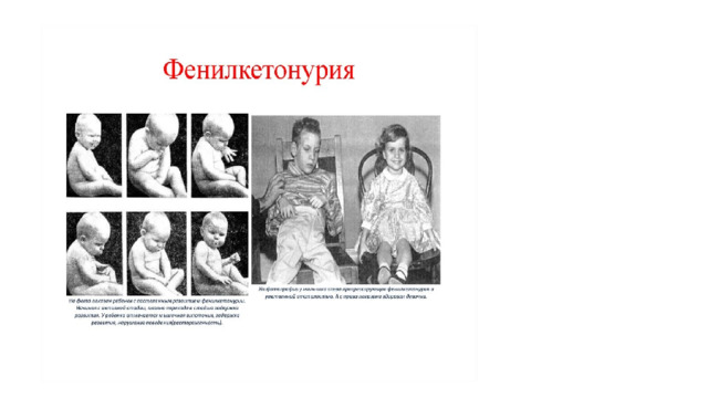 Классификация Фенилкетонурия относится к гиперфенилаланинемиям (состояниям с повышенным уровнем фенилаланина)  . Их делят на два типа: ФАГ-зависимая — связанная с дефицитом фермента ФАГ (по МКБ-10 классифицируется как E70.0 — классическая фенилкетонурия); ФАГ-независимая — связанная с нарушением биосинтеза или восстановления тетрагидробиоптерина (кофермент), который необходим для фермента ФАГ (E70.1 — другие гиперфенилаланинемии). По максимальной концентрации фенилаланина в крови на момент выявления фенилкетонурии у новорожденных болезнь классифицируют по степеням тяжести: легкая, средняя или тяжелая. 
