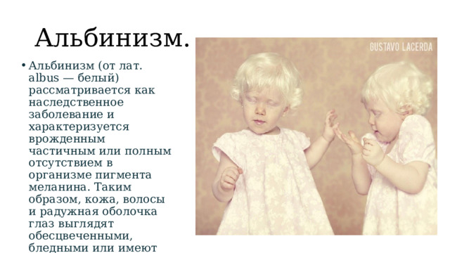 Альбинизм. Альбинизм (от лат. albus — белый) рассматривается как наследственное заболевание и характеризуется врожденным частичным или полным отсутствием в организме пигмента меланина. Таким образом, кожа, волосы и радужная оболочка глаз выглядят обесцвеченными, бледными или имеют более светлый оттенок, чем должны были быть в норме.    