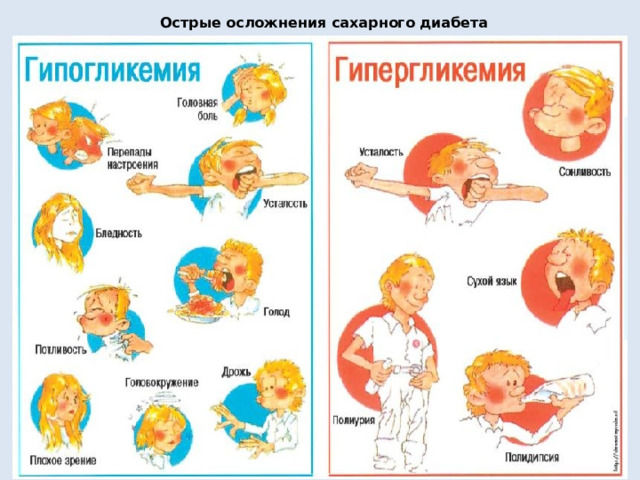 Острые осложнения сахарного диабета 