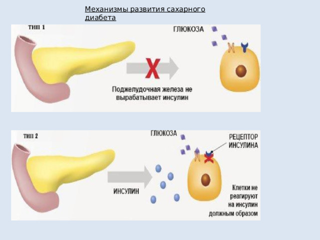 Механизмы развития сахарного диабета 