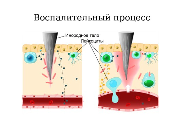 Воспалительный процесс 