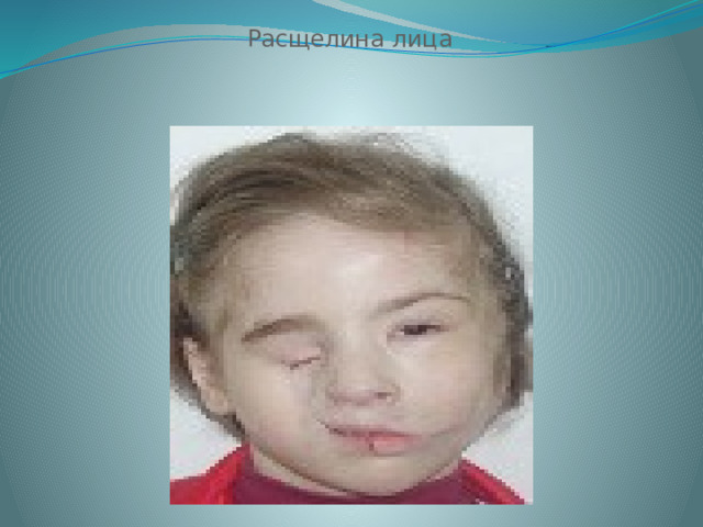  Расщелина лица 
