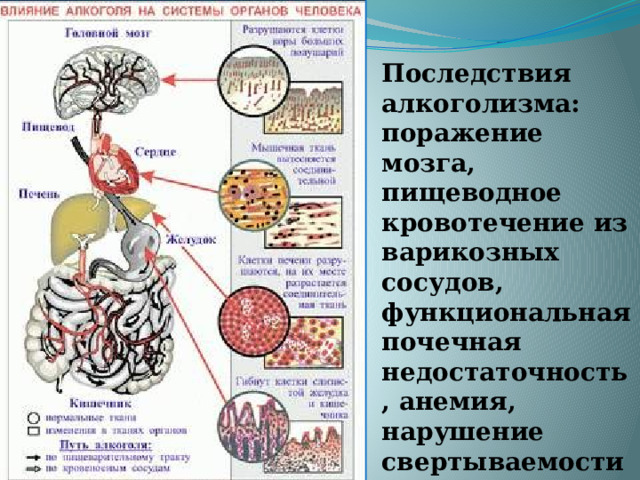Последствия алкоголизма:  поражение мозга, пищеводное кровотечение из варикозных сосудов, функциональная почечная недостаточность, анемия, нарушение свертываемости крови 
