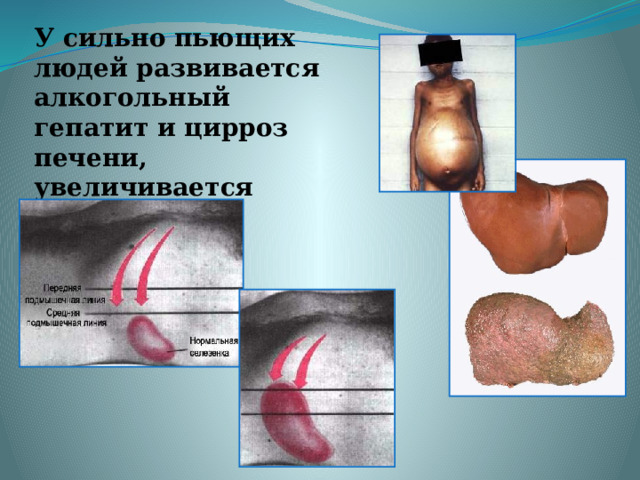 У сильно пьющих людей развивается алкогольный гепатит и цирроз печени, увеличивается селезенка 