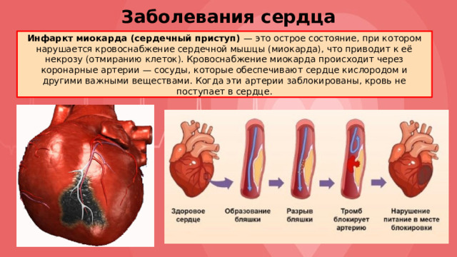 Заболевания сердца Инфаркт миокарда (сердечный приступ) — это острое состояние, при котором нарушается кровоснабжение сердечной мышцы (миокарда), что приводит к её некрозу (отмиранию клеток). Кровоснабжение миокарда происходит через коронарные артерии — сосуды, которые обеспечивают сердце кислородом и другими важными веществами. Когда эти артерии заблокированы, кровь не поступает в сердце. 