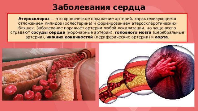 Заболевания сердца Атеросклероз — это хроническое поражение артерий, характеризующееся отложением липидов (холестерина) и формированием атеросклеротических бляшек. Заболевание поражает артерии любой локализации, но чаще всего страдают сосуды сердца (коронарные артерии), головного мозга (церебральные артерии), нижних конечностей (периферические артерии) и аорта . 
