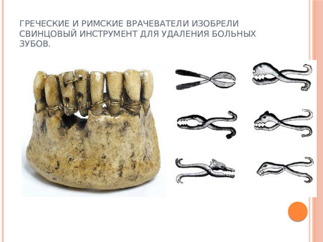 Греческие и римские врачеватели изобрели свинцовый инструмент для удаления больных  зубов. 