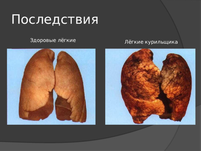 Последствия Здоровые лёгкие Лёгкие курильщика 