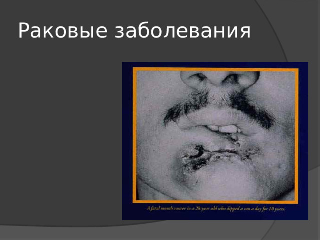 Раковые заболевания 