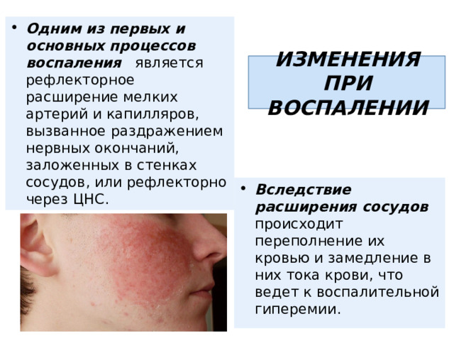 Одним из первых и основных процессов воспаления является рефлекторное расширение мелких артерий и капилляров, вызванное раздражением нервных окончаний, заложенных в стенках сосудов, или рефлекторно через ЦНС. ИЗМЕНЕНИЯ ПРИ ВОСПАЛЕНИИ Вследствие расширения сосудов происходит переполнение их кровью и замедление в них тока крови, что ведет к воспалительной гиперемии.  