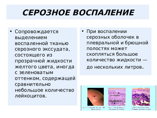  СЕРОЗНОЕ ВОСПАЛЕНИЕ   Сопровождается выделением воспаленной тканью серозного экссудата, состоящего из прозрачной жидкости желтого цвета, иногда с зеленоватым оттенком, содержащей сравнительно небольшое количество лейкоцитов. При воспалении серозных оболочек в плевральной и брюшной полостях может скопляться большое количество жидкости — до нескольких литров .  
