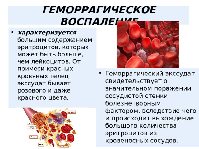  ГЕМОРРАГИЧЕСКОЕ ВОСПАЛЕНИЕ   характеризуется большим содержанием эритроцитов, которых может быть больше, чем лейкоцитов. От примеси красных кровяных телец экссудат бывает розового и даже красного цвета. Геморрагический экссудат свидетельствует о значительном поражении сосудистой стенки болезнетворным фактором, вследствие чего и происходит выхождение большого количества эритроцитов из кровеносных сосудов.  