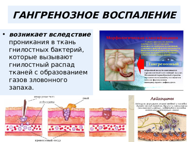  ГАНГРЕНОЗНОЕ ВОСПАЛЕНИЕ   возникает вследствие проникания в ткань гнилостных бактерий, которые вызывают гнилостный распад тканей с образованием газов зловонного запаха.  