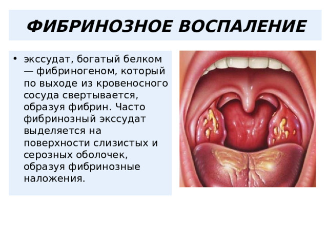  ФИБРИНОЗНОЕ ВОСПАЛЕНИЕ   экссудат, богатый белком — фибриногеном, который по выходе из кровеносного сосуда свертывается, образуя фибрин. Часто фибринозный экссудат выделяется на поверхности слизистых и серозных оболочек, образуя фибринозные наложения. 