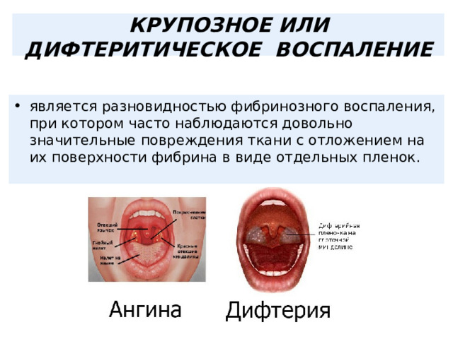  КРУПОЗНОЕ ИЛИ ДИФТЕРИТИЧЕСКОЕ ВОСПАЛЕНИЕ   является разновидностью фибринозного воспаления, при котором часто наблюдаются довольно значительные повреждения ткани с отложением на их поверхности фибрина в виде отдельных пленок. 