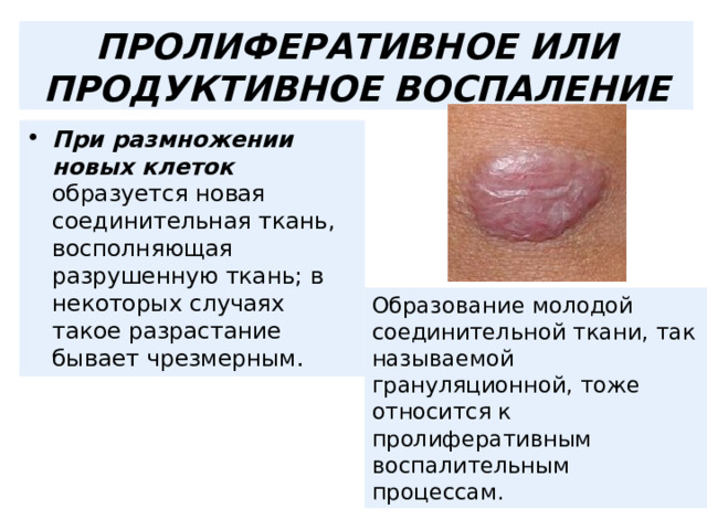 ПРОЛИФЕРАТИВНОЕ ИЛИ ПРОДУКТИВНОЕ ВОСПАЛЕНИЕ При размножении новых клеток образуется новая соединительная ткань, восполняющая разрушенную ткань; в некоторых случаях такое разрастание бывает чрезмерным. Образование молодой соединительной ткани, так называемой грануляционной, тоже относится к пролиферативным воспалительным процессам. 