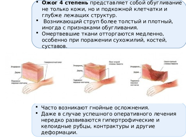 Ожог 4 степень представляет собой обугливание не только кожи, но и подкожной клетчатки и глубже лежащих структур.  Возникающий струп более толстый и плотный, иногда с признаками обугливания. Омертвевшие ткани отторгаются медленно, особенно при поражении сухожилий, костей, суставов. Часто возникают гнойные осложнения. Даже в случае успешного оперативного лечения нередко развиваются гипертрофические и келоидные рубцы, контрактуры и другие деформации. 