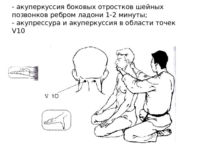 - акуперкуссия боковых отростков шейных позвонков ребром ладони 1-2 минуты;  - акупрессура и акуперкуссия в области точек V10 