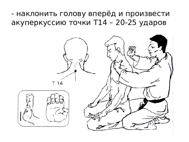- наклонить голову вперёд и произвести акуперкуссию точки T 14 – 20-25 ударов 