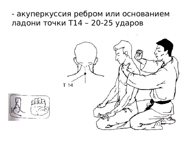- акуперкуссия ребром или основанием ладони точки T14 – 20-25 ударов 