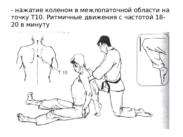 - нажатие коленом в межлопаточной области на точку T10 . Ритмичные движения с частотой 18-20 в минуту 