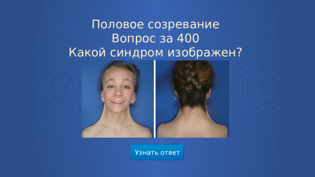 Половое созревание  Вопрос за 400  Какой синдром изображен? Узнать ответ  