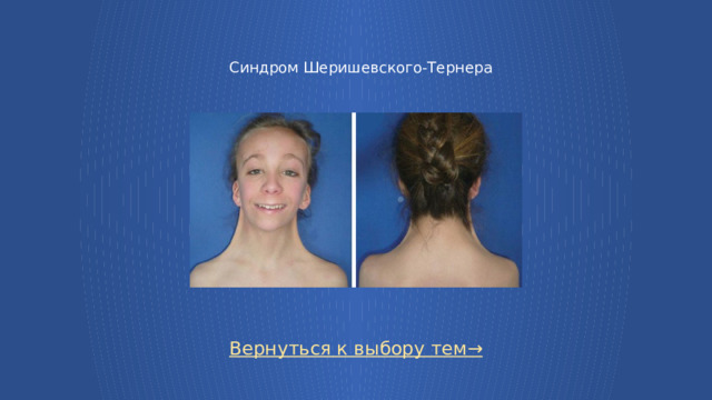 Синдром Шеришевского-Тернера Вернуться к выбору тем→  