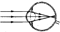 На рисунке приведена схема хода лучей внутри глаза какому дефекту зрения дальнозоркости
