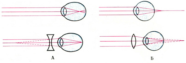 Дефекты зрения близорукость. Дефекты глаза дальнозоркость. Эмметропия миопия гиперметропия. Коррекция близорукости и дальнозоркости.