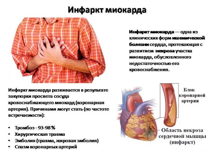 Симптомы микроинфаркта у женщин