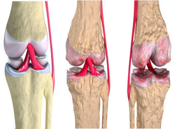 Поражение крупных суставов. Остеоартрит локтевого сустава. Деформирующий артроз (остеоартроз). Артрозо-артрит коленного сустава.